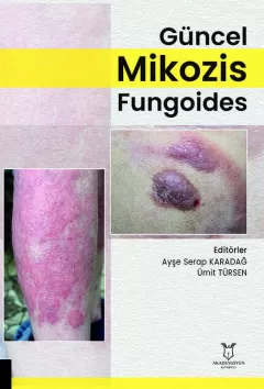 Güncel Mikozis Fungoides