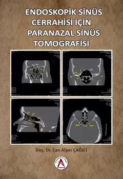 Endoskopik Sinüs Cerrahisi İçin Paranazal Sinüs Tomografisi