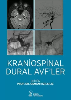 Kraniospinal Dural AVF’ler